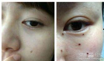 点痣可以吃瓜嘛,美味瓜果可否享用？揭秘术后饮食禁忌  第3张