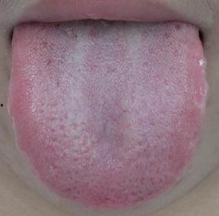 吃瓜舌头刺痛发麻,揭秘背后的健康隐患  第3张